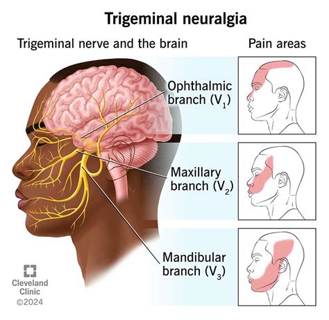 Trigeminal Neuralgia: What It Is, Causes, Symptoms & Treatment