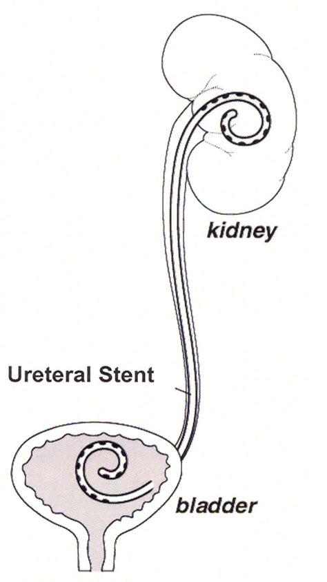 Laser Lithotripsy