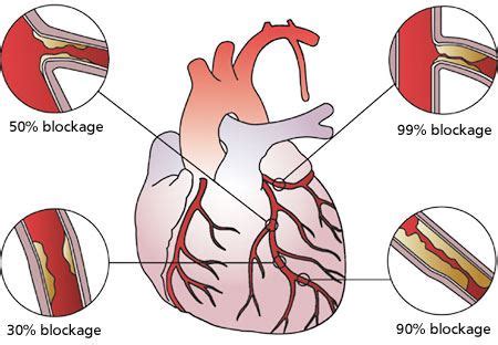 Coronary Artery Disease - Symptoms | Causes & Treatment | Byju's