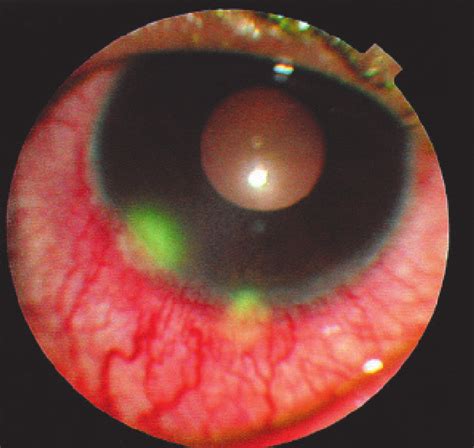 Peripheral ulcerative keratitis. | Download Scientific Diagram