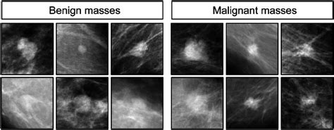 GitHub - mmaithani/Cancer-prediction-using-mammogram-data-: Predicting ...