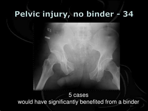 PPT - Is the Application of Pelvic Binders by Pre-Hospital Care Providers justified and ...