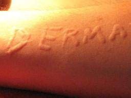 Dermatographia: Causes and treatment of skin writing