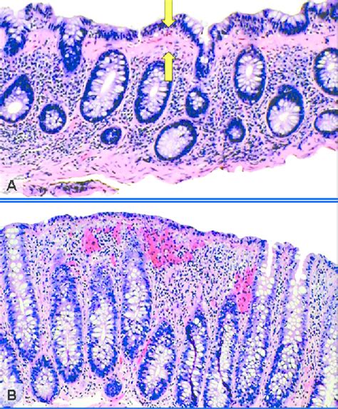 Histological features of microscopic colitis. (A) Collagenous colitis... | Download Scientific ...