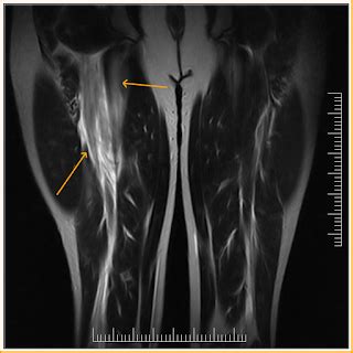 Biceps Femoris Tear-MRI - Sumer's Radiology Blog