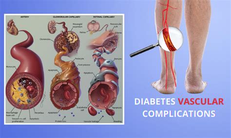 How to Avoid Most Common Diabetes Vascular Complications?