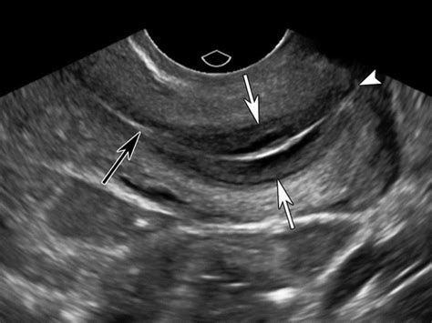 Us Of The Nongravid Cervix With Multimodality Imaging Correlation ...