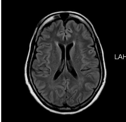 Choroid Plexus Xantogranulomata-MRI - Sumer's Radiology Blog