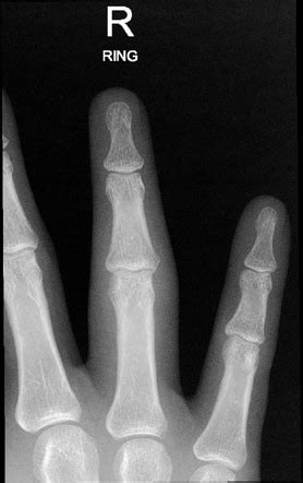 Phalanx fracture | Radiology Case | Radiopaedia.org