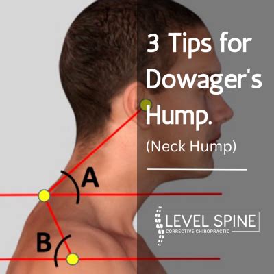 Fixing neck hump - what can I do? - GETTING SPINES HEALTHY AGAIN