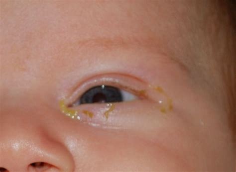 Blocked Tear Duct: Symptoms, Causes And Treatment