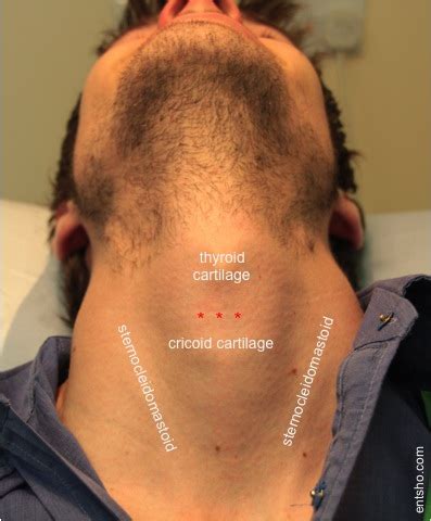 Needle Cricothyroidotomy — entsho.com