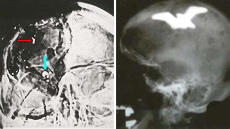 EXCLUSIVE: JFK autopsy 'bullet fragment' X-ray was faked, denounced as ...