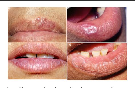 Figure 1 from Lichen Planus Affecting the Lips | Semantic Scholar