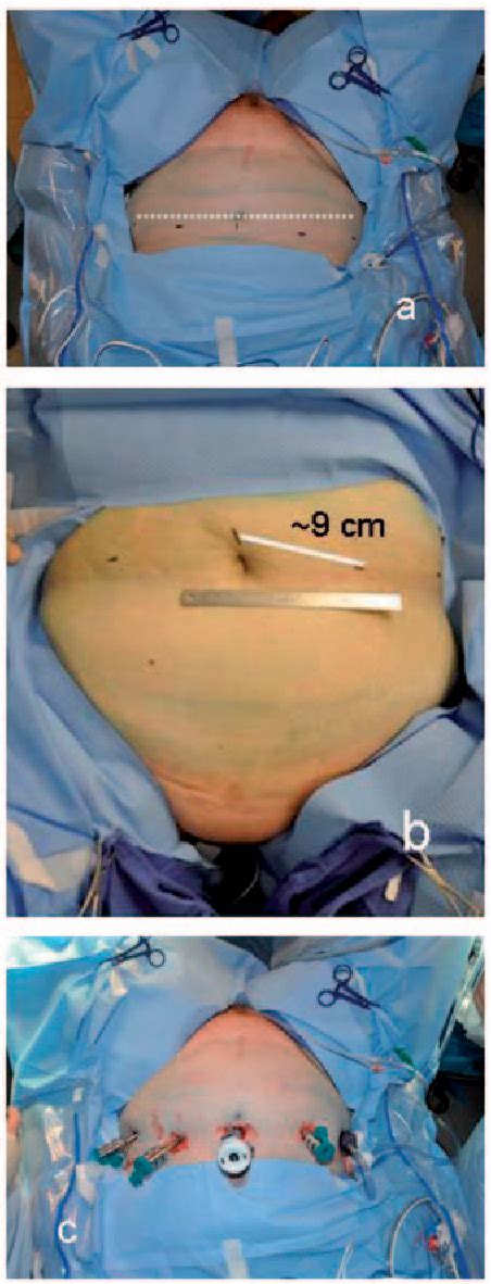 Figure 1 from Robotic-assisted laparoscopic mesh sacrocolpopexy ...