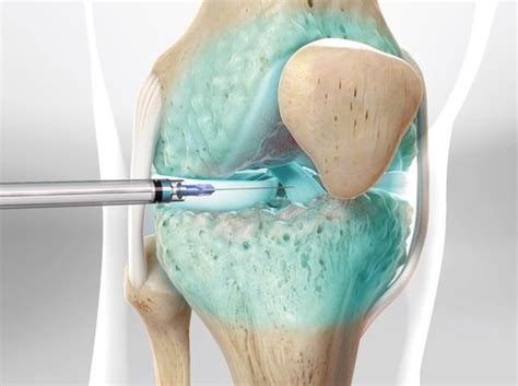 Video - Steroid Injection for Knee Pain (Fluoroscopic-Guided Method ...