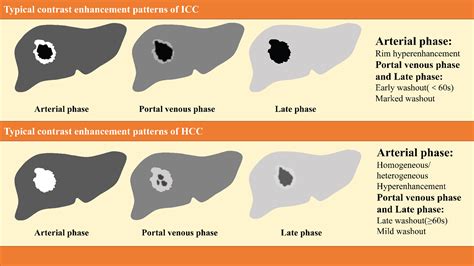 Differentiation between hepatocellular carcinoma and intrahepatic ...