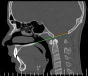 Basilar invagination | Radiology Reference Article | Radiopaedia.org | Radiology, Reference ...