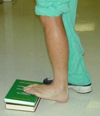 Calcaneal Bursitis Treatment & Management: Rehabilitation Program ...