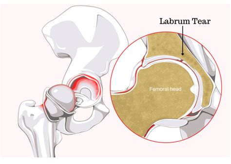 Hip Labrum Tear | Orthopedic Hip Specialist | Sugar Land, Pearland ...