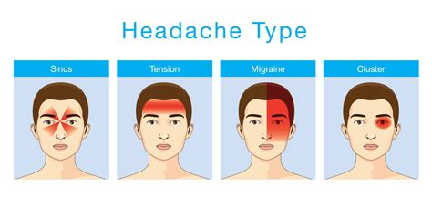 VA Migraines Rating Criteria - Top 3 Tips Revealed