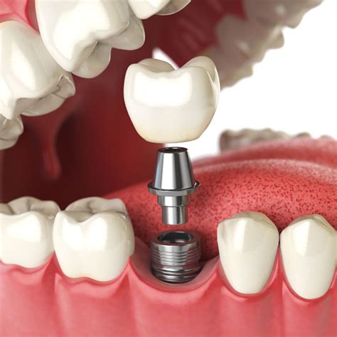 Dental Implants Near Me | Prosper, TX 75078