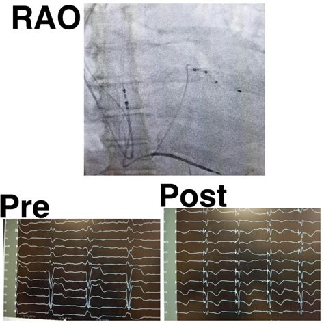 David Kenigsberg, MD, FHRS on LinkedIn: 75 year old patient with LBBB ...