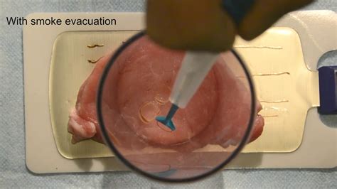 CIMPAX C-VAC Tornado Cervical biopsy Demo - YouTube