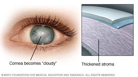 Corneal Endothelial Dystrophy - First Eye Care Irving