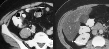 Appendicitis Imaging Workup: Radiography, Computed Tomography, Magnetic Resonance Imaging