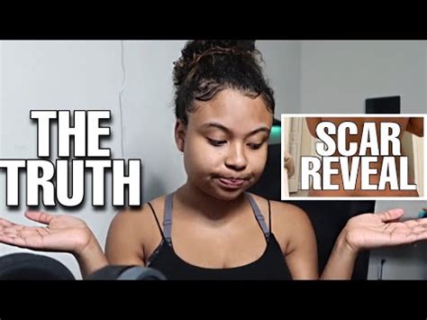 THE TRUTH ABOUT MY BBL EXPERIENCE (REVEALING MY SCARS & POST OP ...