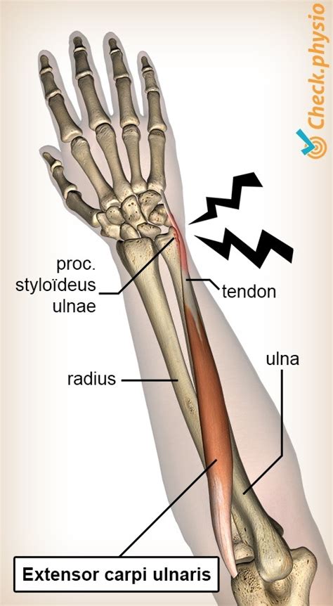 Extensor carpi ulnaris tendinopathy | Physio Check