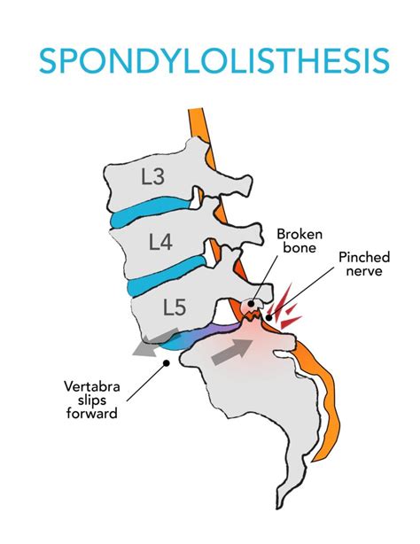 Complete Car Physio - Spondylolisthesis Exercises