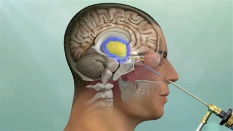 Keyhole Procedure Videos - Pacific Neuroscience Institute