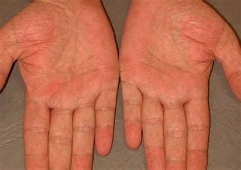 👉 Palmar Erythema - Pictures, Causes, Treatment (December 2021)