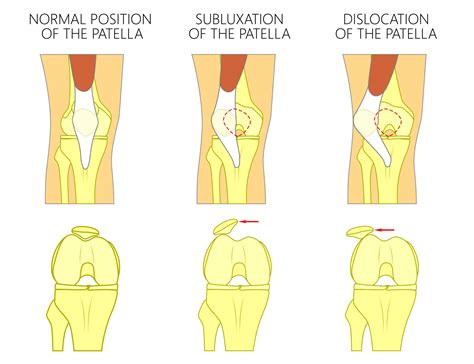 Patellar dislocation and recurrent patellar dislocation - Knee, Hip and ...