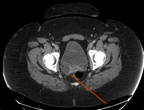 CT urogram with arrow pointing out ectopic insertion of dilated upper ...