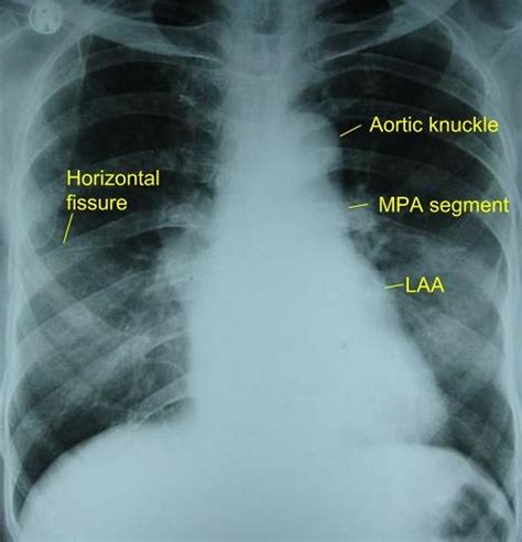 Mitral stenosis – X-ray chest PA view – All About Cardiovascular System ...