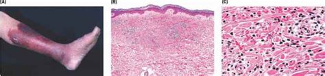 Perivascular And Interstitial Dermatitis - Dermatopathology