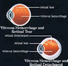 Vitreous Hemorrhage with Retinal Tear & Retinal Detachment — Cumberland ...