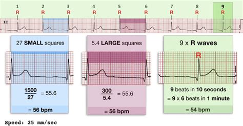 Ecg Heart Rate Calculation