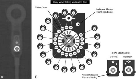 Determining Settings of Programmable VP Shunts | UW Emergency Radiology