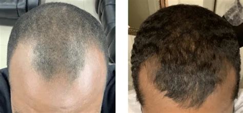 Minoxidil Before And After Men