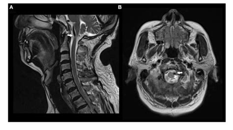 Figure 1 from Vertebral Artery Compression Syndrome | Semantic Scholar