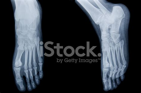 Human Leg X Ray Stock Photos - FreeImages.com