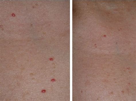 Cherry Angiomas Laser Treatment | Lafayette, LA | Renewed Med Spa