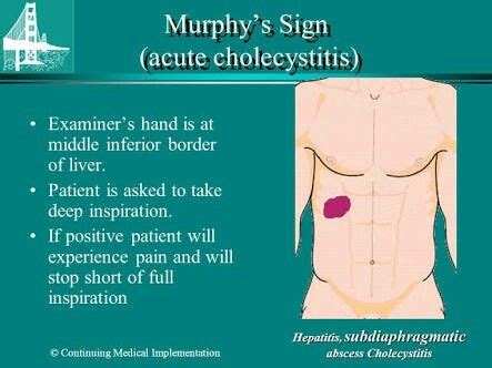 Murphy's sign | Murphy sign, Nursing school tips, Nursing students