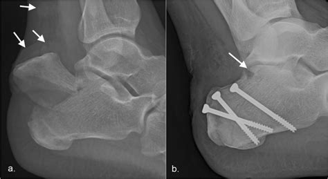 Intra-articular tongue-type fractures of the calcaneus: anatomy, injury ...