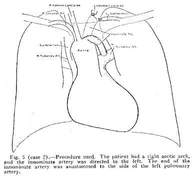 Journal Club: History: Blalock-Taussig Shunt Original 1945 JAMA Paper