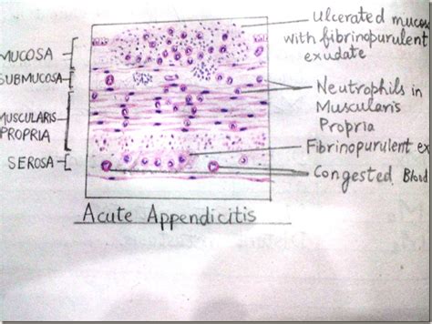 Histology Slides Database: Acute appendicitis handmade histopathology ...